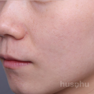 흉터 시술 후 이미지