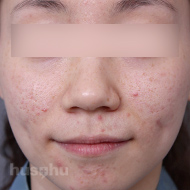 흉터 시술 전 이미지