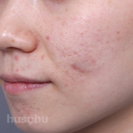 흉터 시술 전 이미지