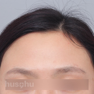 이마필러 시술 전 이미지