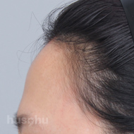 이마필러 시술 전 이미지