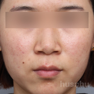 여드름 시술 후 이미지