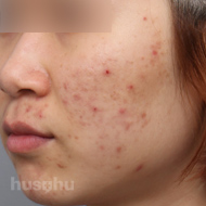 여드름 시술 전 이미지