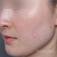 안면홍조 시술 후 이미지