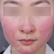 안면홍조 시술 전 이미지