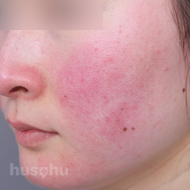 안면홍조 시술 전 이미지