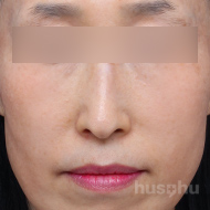 기미색소 시술 후 이미지