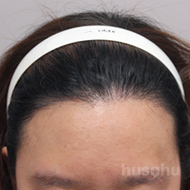 모발이식 시술 후 이미지