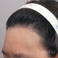 모발이식 시술 후 이미지