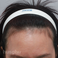 모발이식 시술 전 이미지