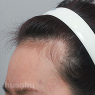모발이식 시술 전 이미지